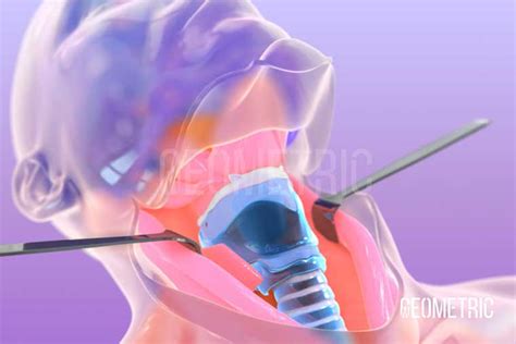Total laryngectomy: 3D anatomy .